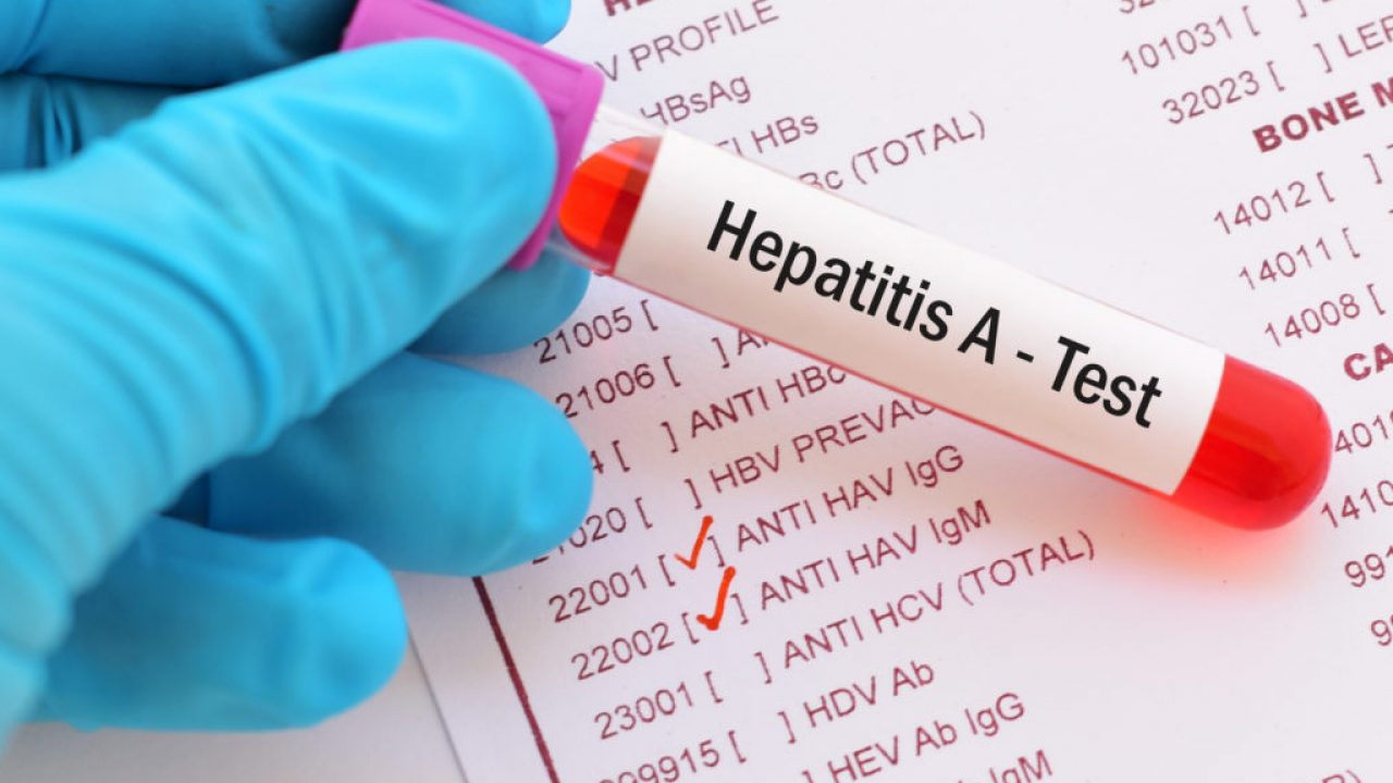 Peste 500 de cazuri de hepatita virala A, confirmate, in judetul Bihor. Dublu fata de anul 2017