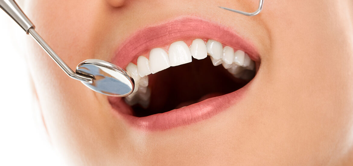 9 mituri despre fațetele dentare