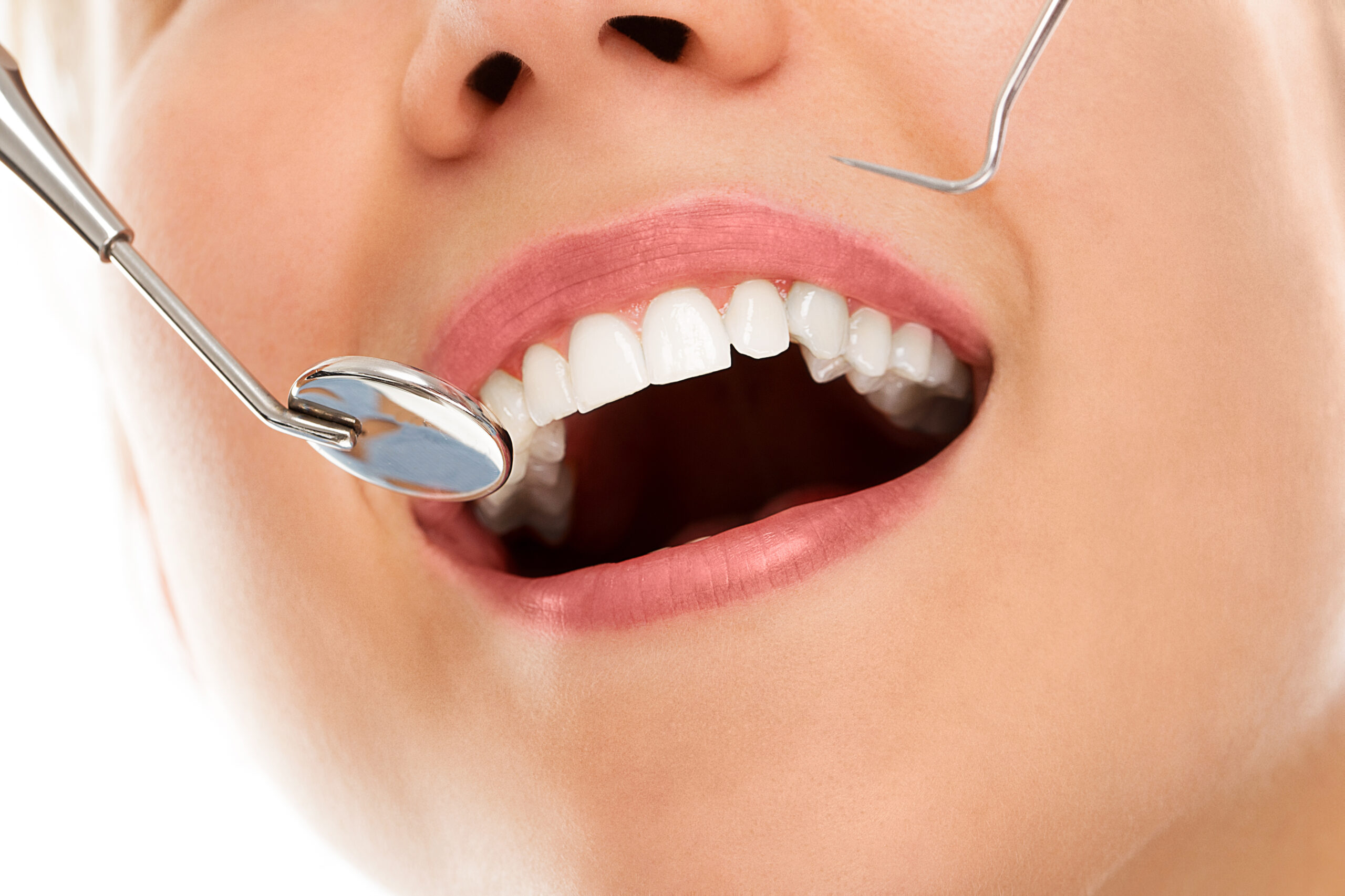 9 mituri despre fațetele dentare
