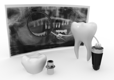 Ce nu știi încă despre implanturile dentare?