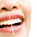 Mituri și adevăruri despre albirea dinților