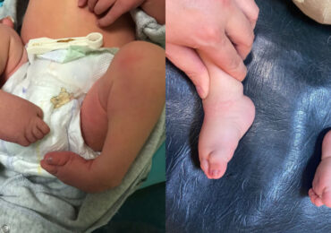 Intervenții chirurgicale complexe pentru nou-născuți și copii la Spitalul Judetean Oradea